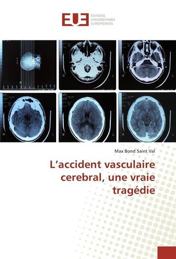 Couverture du livre « L'accident vasculaire cerebral, une vraie tragedie » de Val Max Bond Saint aux éditions Editions Universitaires Europeennes